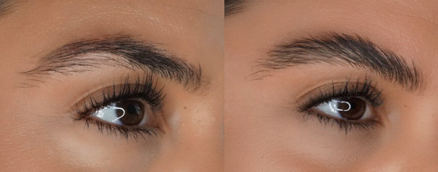 Vorher Nachher Brow Lifting